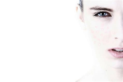 The 4 Main Causes Of Acne | Science Becomes Her