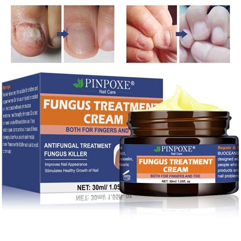 Buy Fungus Cream, Nail Fungus Cream, Fungus Stop, Foot Fungus, Nail Repair, Restores the y ...