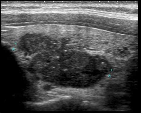 WK 1 THYROID Papillary thyroid cancer | Radiology Reference Article ...