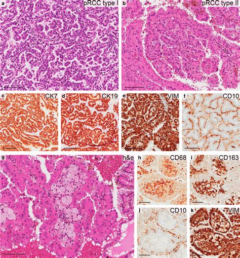 Histology of papillary RCC. Hematoxylin and eosin staining of papillary... | Download Scientific ...