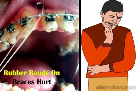 Why Do Rubber Bands On Braces Hurt? [9 Pain Relieving Tips ...