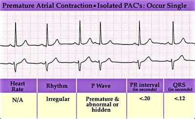 Sinus rhythm with pac ecg 671152-Sinus rhythm with pac treatment