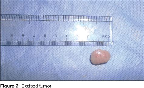 Figure 5 from Intraoral neurilemmoma of mental nerve mimicking as ...