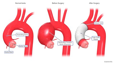 Thoracic Aortic Aneurysm | The Patient Guide to Heart, Lung, and ...