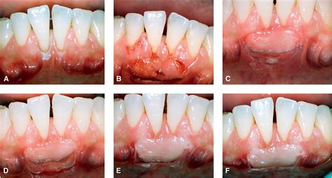 Gingival Graft