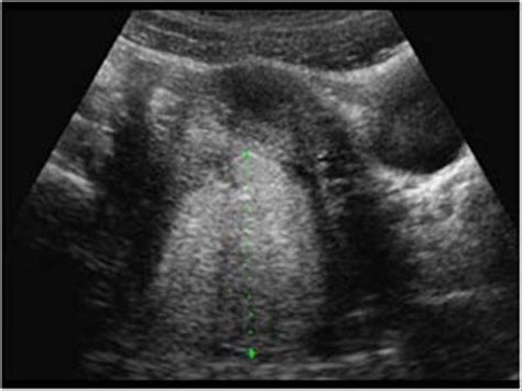 Gynaecology | 3.2 Adnexa : Case 3.2.2 Dermoid cysts / cystic teratomas ...