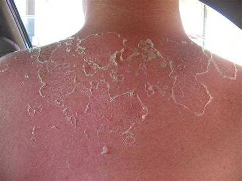 2006.06.11 P's Blistering Sunburn | P probably should have g… | Flickr