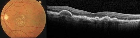 Age Related Macular Degeneration - Retina & Eye Consultants