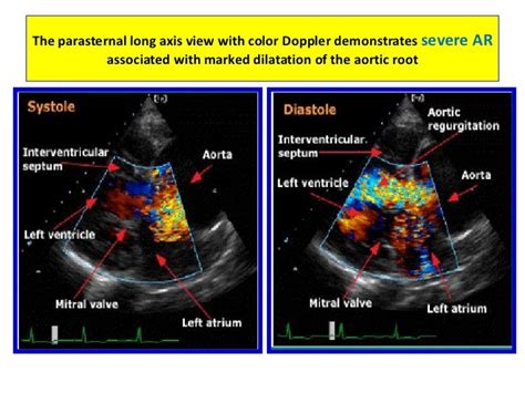 Basics of echo & principles of doppler echocardiography