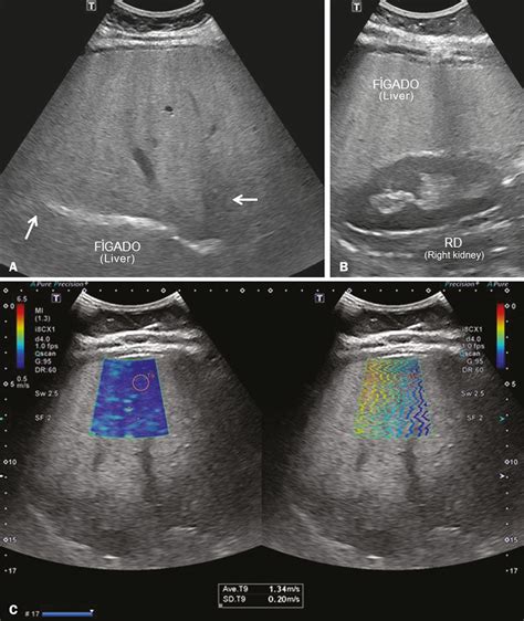 Liver Fibrosis Ultrasound