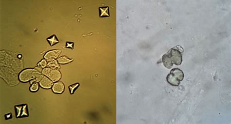 Calcium Oxalate Crystals - Nephrology in 30 days