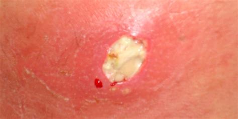 MRSA infection Symptoms, Causes, Complications, Diagnosis and Treatment | Natural Health News