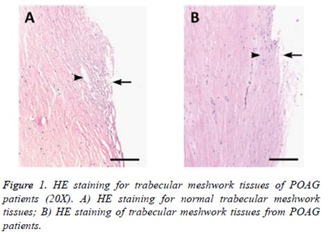 Expression of eNOS and CAV gene in trabecular meshwork cells and effects on glaucoma pathogenesis