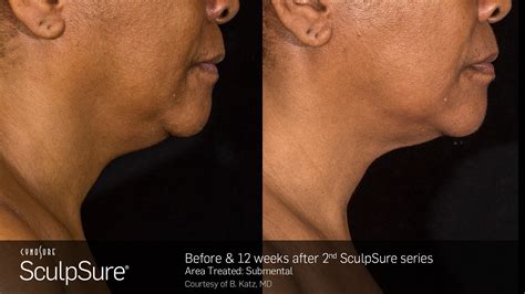 SculpSure Fat Reduction | Auburn, WA | Luma Med Spa