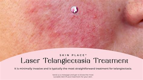 Skin Place Laser Telangiectasia Treatment - YouTube