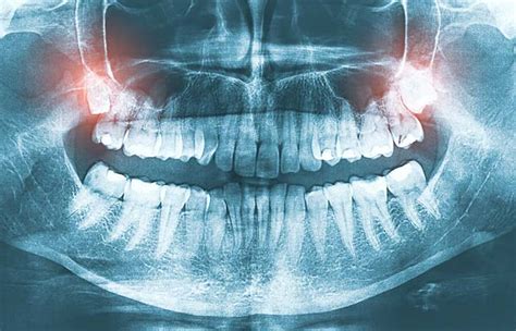 Common Signs to Get Wisdom Teeth Removed | Absolute Dental