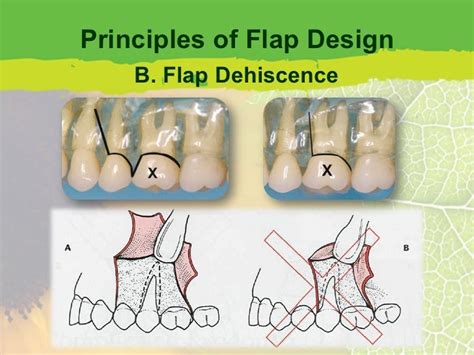 Flap Design for Minor Oral Surgery