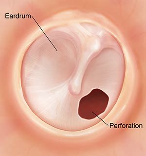 Ruptured Eardrum