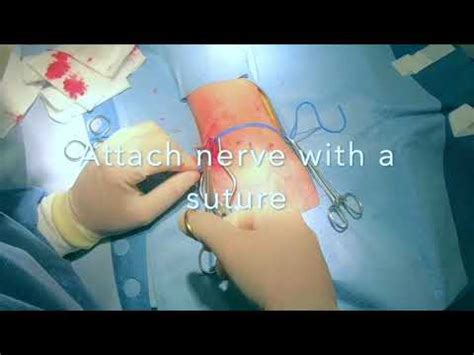 Sural nerve biopsy procedure - YouTube