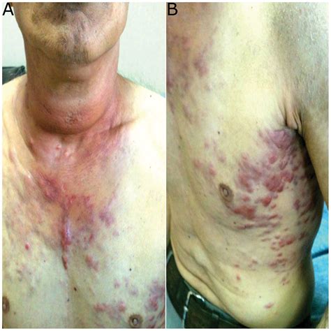 Anaplastic thyroid carcinoma with diffuse thoracic skin metastasis: A case report