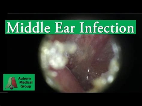 Ear Infection Pain Treatment in an Adult | Auburn Medical Group - The ...