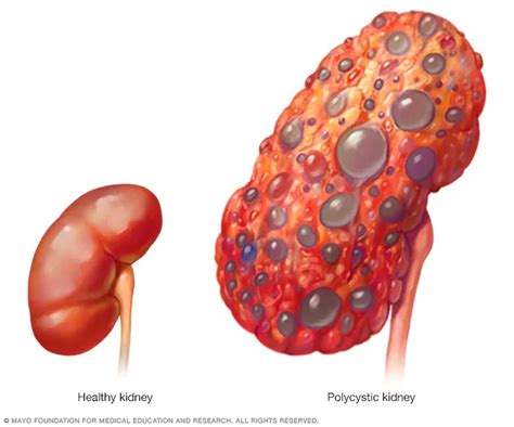 Polycystic kidney disease - Symptoms and causes - Mayo Clinic