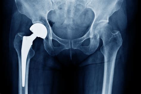 ortho-total-hip-replacement-x-ray | MSO Physiotherapy