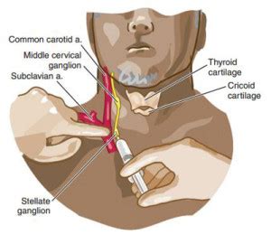 Stellate Ganglion Block - Dr. Michael A. Castillo, MD