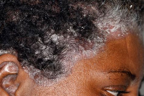 Pictures Of Sores And Scabs On Scalp: Causes And More, 59% OFF