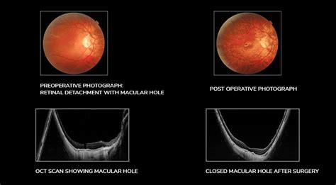 Retinal Detachment: Symptoms Archives - Neoretina Blog