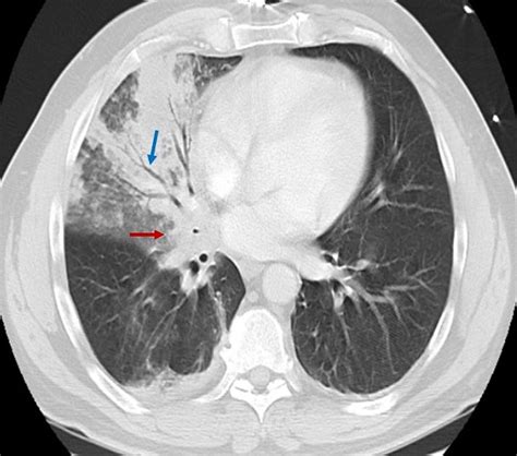 Cureus | The Hurricane Lung: A Case of Hydrocarbon Pneumonitis With Abscess Formation Following ...