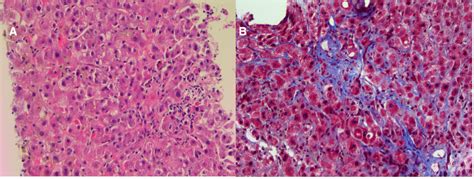 Fibrosing cholestatic hepatitis after kidney transplantation from HCV ...