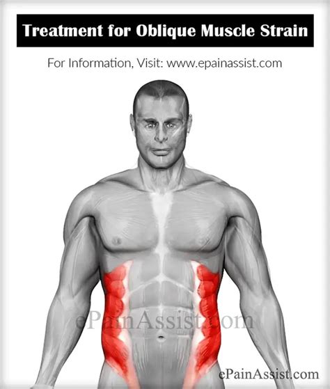 Oblique Muscle Strain|Causes|Symptoms|Treatment|Recovery