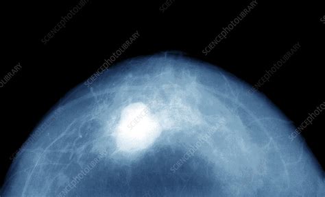 Breast cancer, X-ray - Stock Image - M122/0419 - Science Photo Library