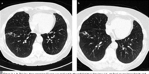 What Is A Low Dose Ct Lung Scan - Image to u