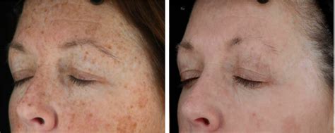 Sun Damage & Sun Spots Removal | London Premier Laser Clinic