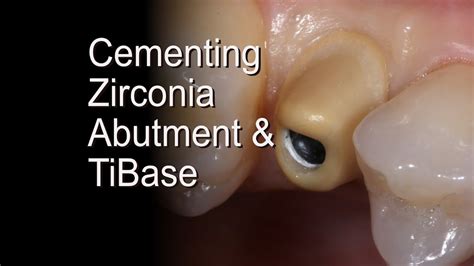 Dental Zirconia Implant Abutments - YouTube