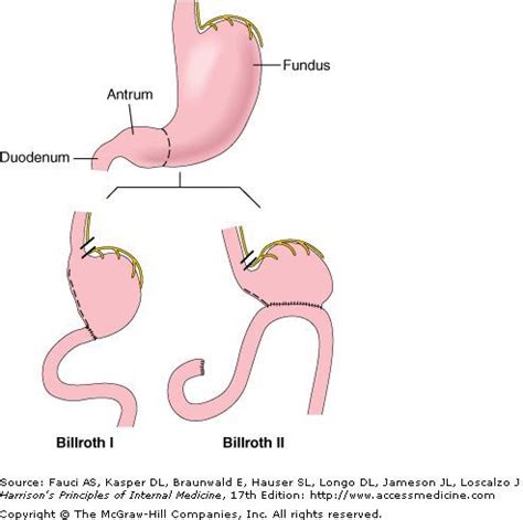 Billroth 1 vs. Billroth | Surgical nursing, Medical jokes, Surgical tech