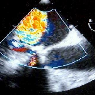 (PDF) Intravalvular regurgitation of the mitral bioprosthetic valve detected by intraoperative ...