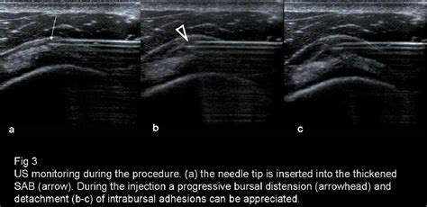 Subdeltoid Bursitis Ultrasound