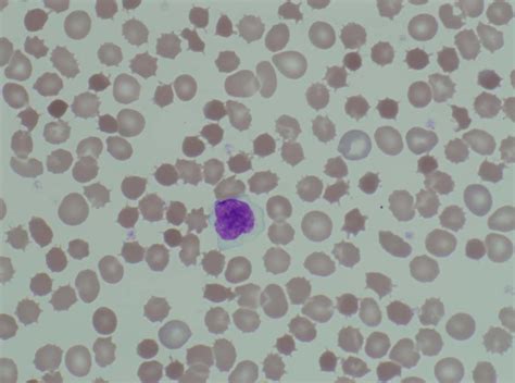 Acanthocytosis