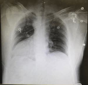 Dextrocardia: Can you pick it on ECG? | Resus