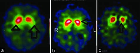 Dopamine Transporter (DaT) scan type 1 abnormality. (a) Left side shows... | Download Scientific ...