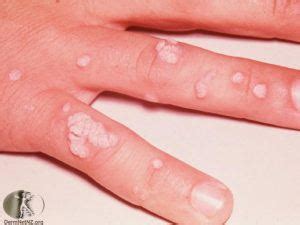 Common Warts | Craig Singer MD Dermatology