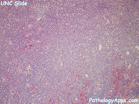 dlbcl hematopathology