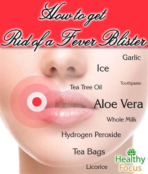 Perfect How To Get Rid Of Fever Blisters On Your Lip Fast And View in ...