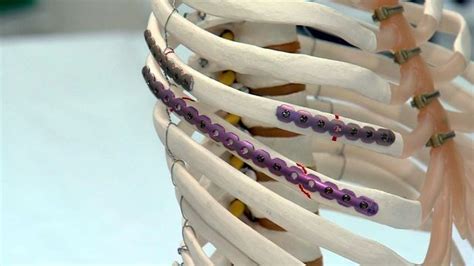 New 'rib plating' procedure helps patients of broken ribs | Broken ribs, Body healing, Healing