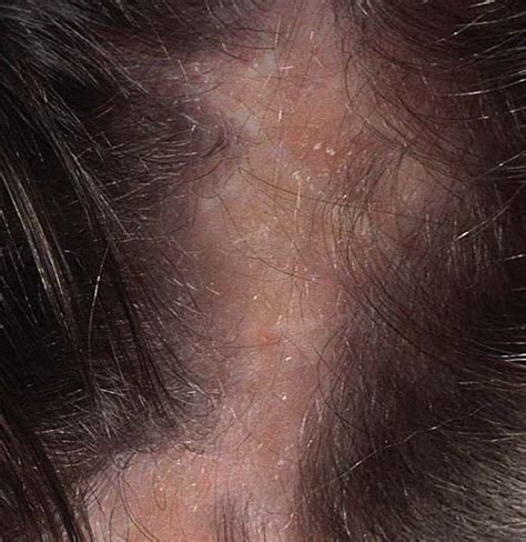 Scalp Fungal Infection