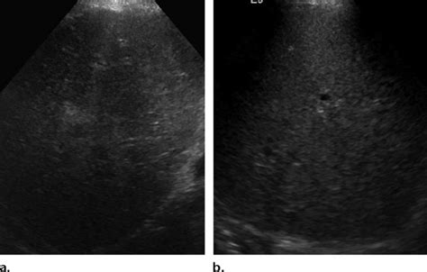 Increased hepatic echogenicity in a 44-year-old patient. (a) Gray-scale ...