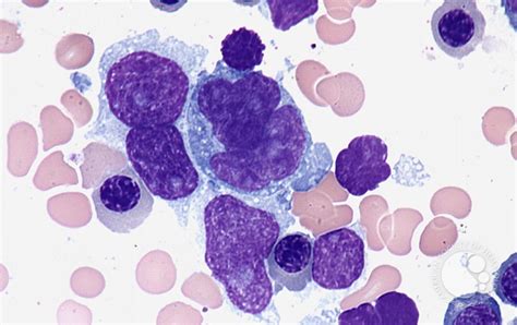 Diffuse large B-cell lymphoma - bone marrow aspirate - 2.